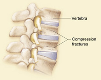 Is Your Back Pain a Spine Compression Fracture? - Virginia Spine