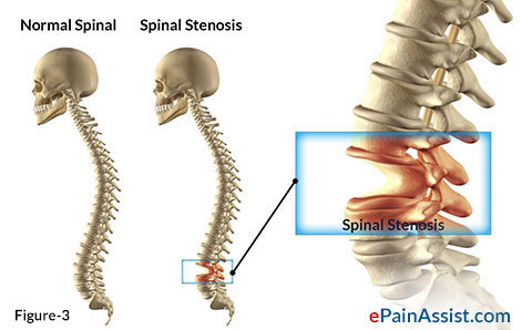 7 Facts You May Not Know About Spinal Stenosis