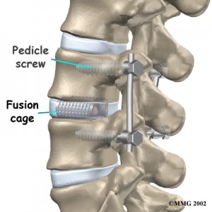 Spinal fusion surgery 101