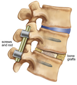 How To Make Your Spinal Fusion Surgery A Success Virginia Spine 