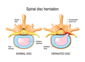 Herniated Disc - Virginia Spine Specialists