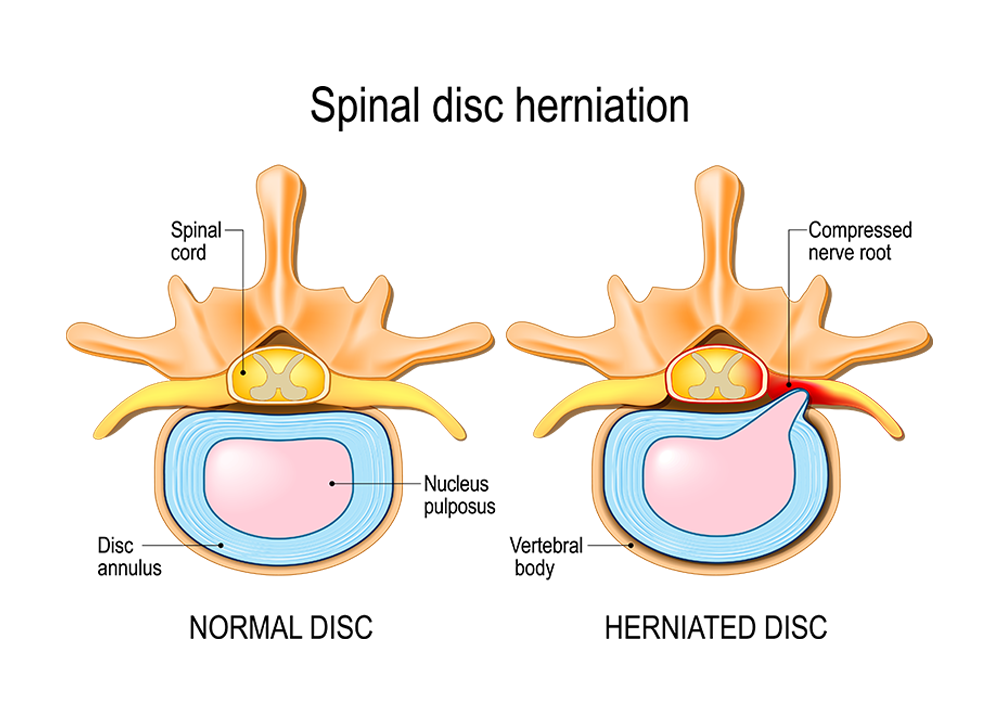Herniated Disc - Virginia Spine Specialists