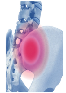 SacroiliacSI Joint Treatment