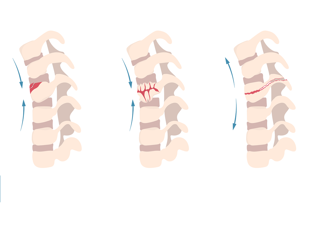 Spinal Fracture