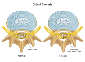 Spinal Stenosis Treatment - Virginia Spine Specialists