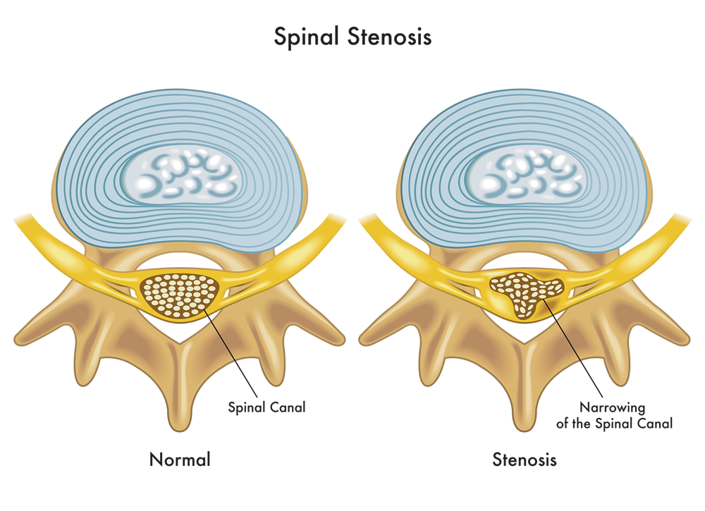 Spinal Stenosis Treatment - Virginia Spine Specialists