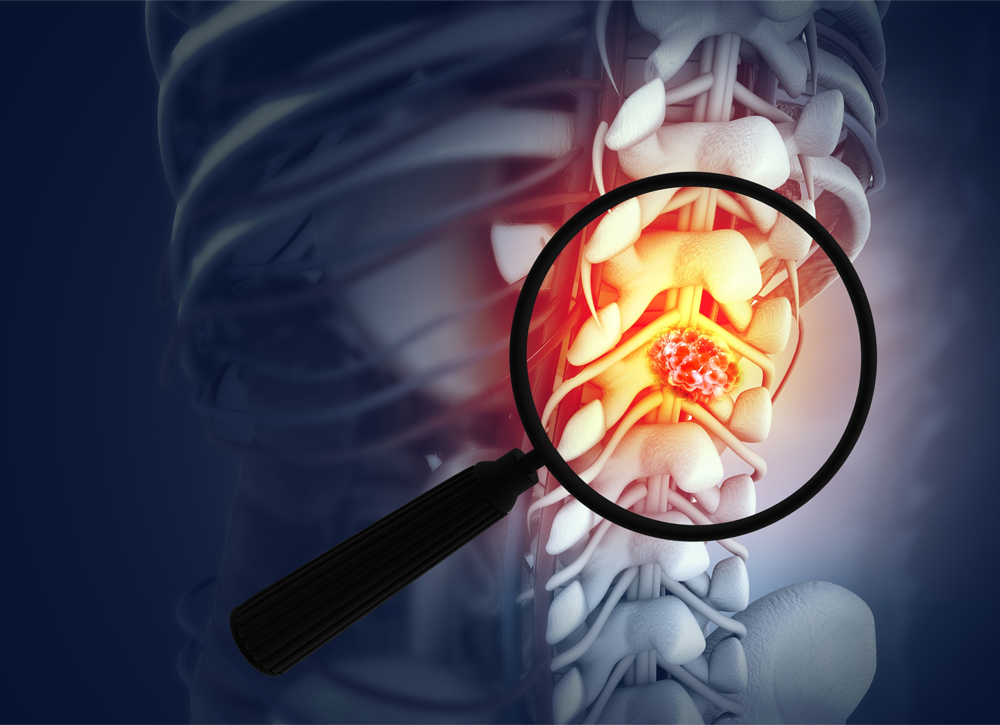 Spinal Tumor